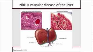 Nonviral Hepatitis and hepatoxicity presented by Patrick Ingiliz [upl. by Einnod]