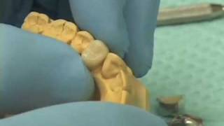 Fabricating Provisional Crowns [upl. by Analat]