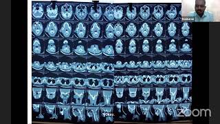 PG CLINICS PAROTID TUMOR SOFT TISSUE TUMOR [upl. by Noivax]