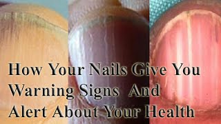 How your Nails give you Warning signs and alert about your health [upl. by Amethist]