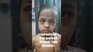 A psoriasisskin disease patients testimony yanungjamohlegoherbal [upl. by Farika743]