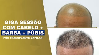 Calvície grau VII  Body Hair Transplant BHT drpaulolu transplantecapilar [upl. by Notlil]