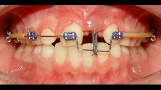 Orthodontic Treatment of an Impacted Dilacerated Upper Central Incisor  Alaa [upl. by Darnoc]