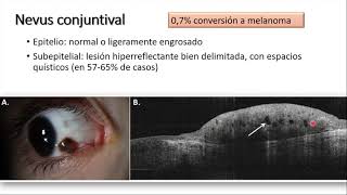 Dra Claudia Echeverry Tomografia de Coherencia Optica OCT de segmento anterior Abril 2023 [upl. by Gnem]