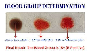 Blood Group Test  Procedure for Determination of Blood Group  Blood Group Determination Test [upl. by Sadonia]