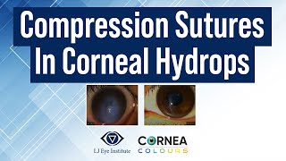 Partial Thickness compression suture for Acute hydrops  Cornea Colours  Season2  Ep2 [upl. by Jahn]