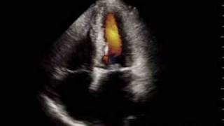 Mitral stenosis video with audible mid diastolic murmur [upl. by Rayna]