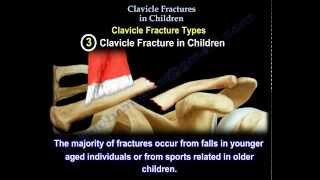 Clavicle Fractures In Children  dont worry the outcome is usually good [upl. by Gona676]