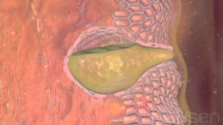 What is Esophageal cancer Treatment Medical animation [upl. by Mik]