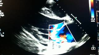 Ecocardiograma  Ruptura de cordolha de valva mitral Echocardiogram  Break cordolha mitral valve [upl. by Mccord]