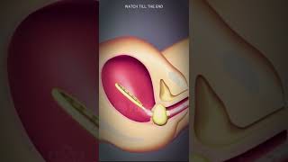 Postpartum bleeding treatment using vaccum What is PPH pregnancy birth postpartum [upl. by Trixy]