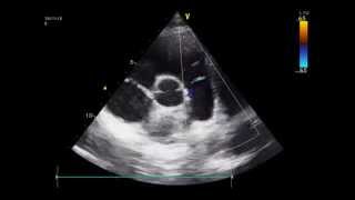 Diastolic flow in the pulmonary artery coronary fistula echo [upl. by Merow]