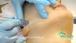 Microdermabrasion step by step demonstration [upl. by Allerie659]