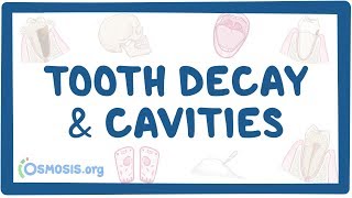 Tooth decay and cavities  causes symptoms diagnosis treatment pathology [upl. by Ahsenyt]