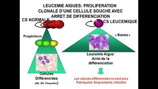 Hemato 12Hémopathies malignes et leucémies aigues Dr Abbadi [upl. by Cerveny]