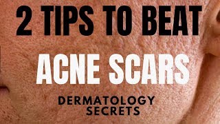 How to treat ACNE SCARS  Dermatologist reveals the best way [upl. by Barabbas]