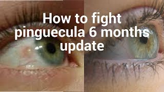 How to fight pinguecula update for 6 months [upl. by Arat30]