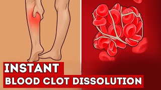 These 7 FOODS Instantly Dissolve Blood Clots in Your Vessels [upl. by Aratihc853]