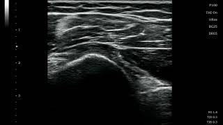 Ultrasound guided injection to Glenohumeral joint [upl. by Ymmik]