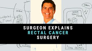 Surgeon Explains Rectal Cancer Surgery [upl. by Kalvn660]