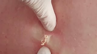 Extraction de gros points noirs et de boutons géants  Meilleures vidéos dextraction de boutons [upl. by Ferguson]