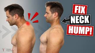 How To Fix Neck Hump At Home Best Stretches and Exercises [upl. by Isacco]