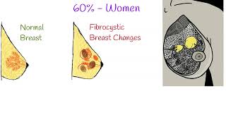 Fibrocystic breast Causes Symptoms and Treatment Fibrocystic Breast Disease [upl. by Alma23]