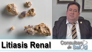 Litiasis Renal  Cirugía Intrarrenal Retrógrada [upl. by Enitnelav]