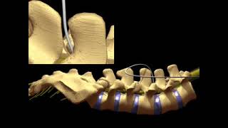 Dr Georgios Matis  Neuromodulation  Intrathecal catheter placement [upl. by Lebiram]