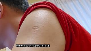 어깨근 근섬유다발수축 deltoid fasciculation 루게릭 ALS 흉내 [upl. by Anelyak]