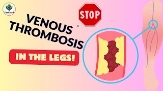 Warning Signs Deep Vein Thrombosis [upl. by Thomajan110]