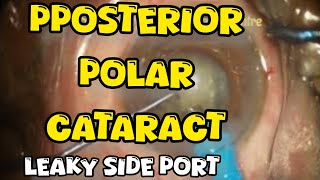 posterior polar cataract with inadvertently enlarged side port managed nicely [upl. by Nevyar143]