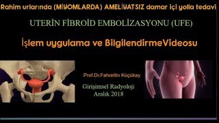 Uterine Fibroid Embolizasyonu UFE [upl. by Mitinger]