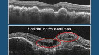 Dry AgeRelated Macular Degeneration AMD vs Choroidal Neovascularization CNV [upl. by Renrag]