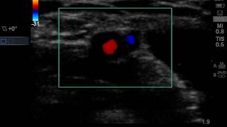 Assessment of the brachial artery and vein in the antecubital fossa with Doppler ultrasound [upl. by Benildas]