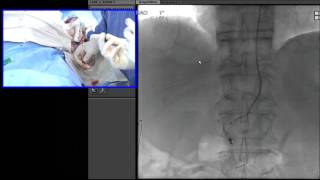 Transradial Embolization of the Right Gastric Artery Prior to Y90 Radioembolization [upl. by Catton]