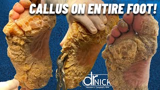 SHAVING CALLUS ON ENTIRE SOLE OF FOOT Dr Nick Campitelli Foot amp Ankle Surgeon [upl. by Enytnoel]