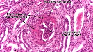 Rapidly Progressive Glomerulonephritis RPGN [upl. by Carie]