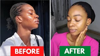 25 DAYS SKIN TRANSFORMATION USING TRETINOINHow Tretinoin saved my Skin Before amp After drpurity [upl. by Einafpets]