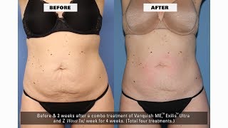 How Z Wave Helps Dr Salzman Get Enhanced Results by 4060 on NonInvasive Fat Reduction Procedures [upl. by Harts]