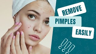 Pimples Removal on Face at Home in Tamil  Easy Pimples Treatment  24 Tamil [upl. by Notnroht986]