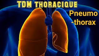 SCANNER THORACIQUE Pneumothorax avec collapsus passif [upl. by Cicily]