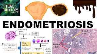 ENDOMETRIOSIS Etiopathogenesis Cinical features and Pathology [upl. by Ecienahs510]