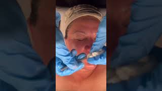 Learn how to properly do nose extractions with a licensed esthetician skinexpert esthetician [upl. by Anaoy]