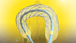 Resolute Integrity Coronary Stent System [upl. by Akiwak66]