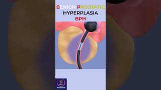 Benign Prostatic Hyperplasia education shorts [upl. by Soane986]