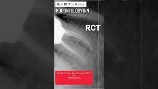 ROOT CANAL TREATMENT CASES WITH EXCELLENT SUCCESS RATE [upl. by Hakaber]