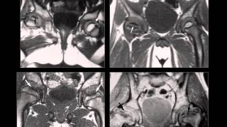 Osteocondrosis Osteocondritis Osteonecrosis Infarto Oseo Radiologia Radiografiaswmv [upl. by Ahsimik]