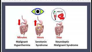 Syndrome malin des neuroleptiques Sérotoninergique Hyperthermie maligne 3 minutes [upl. by Kalbli]