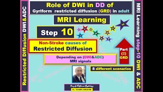 MRI learning Step10 DD of Gyriform restricted diffusion MRI signal whats your plan 8 cases [upl. by Kenward]